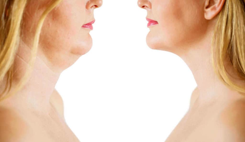 Double Chin treatment Northwich before and after results