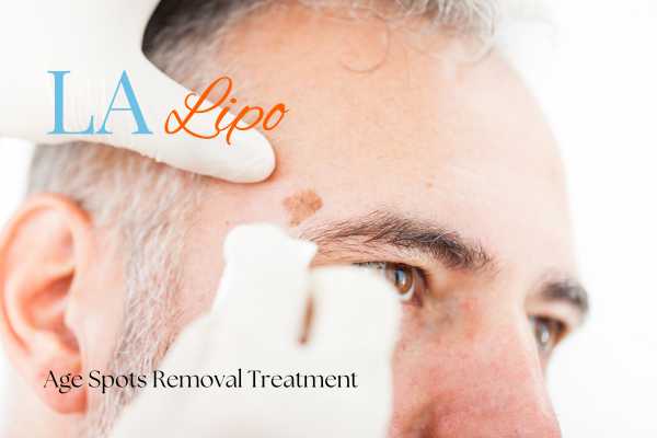 What Are the Most Effective Treatments for Age Spots Northwich?