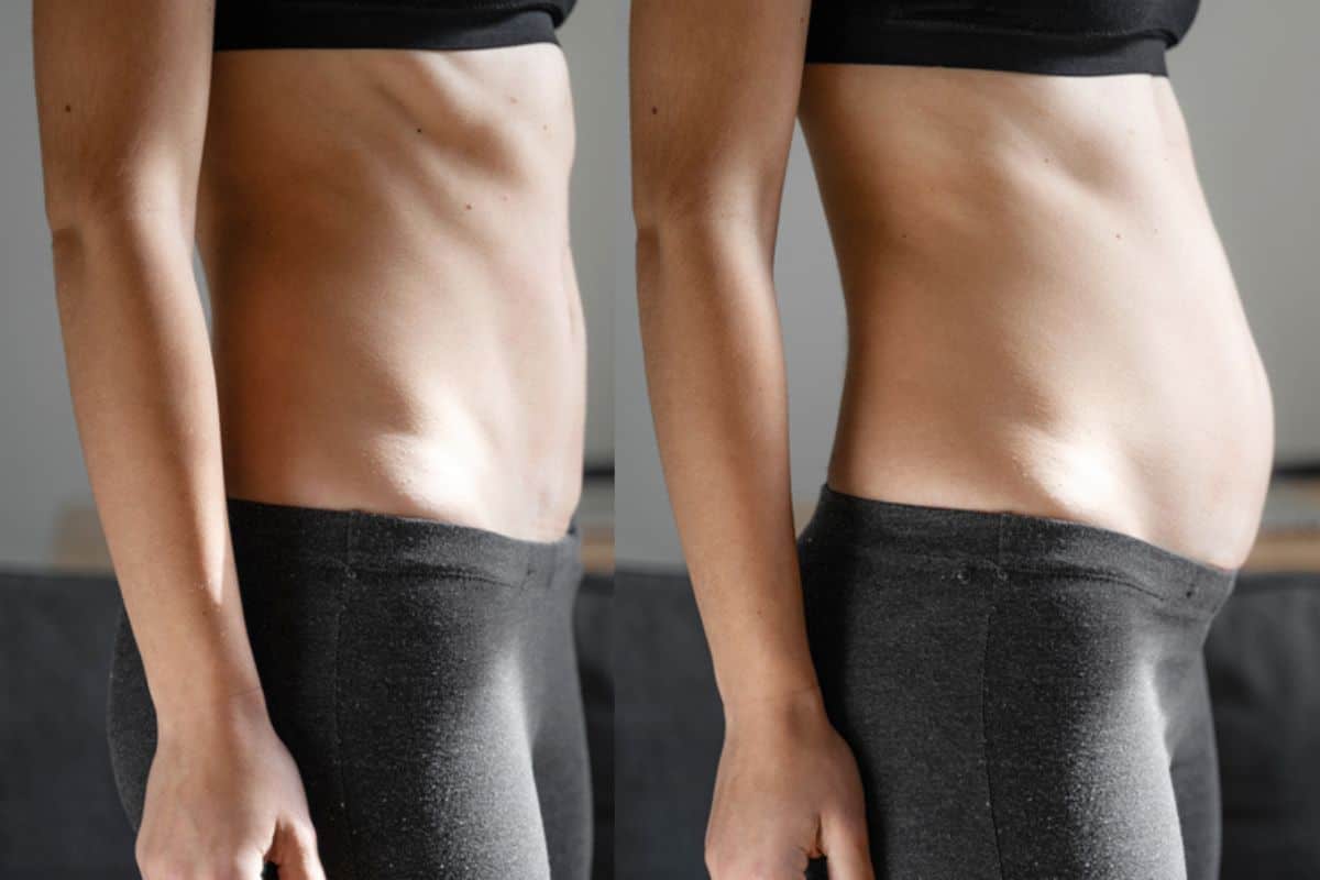 How long does diastasis recti take to improve Northwich?