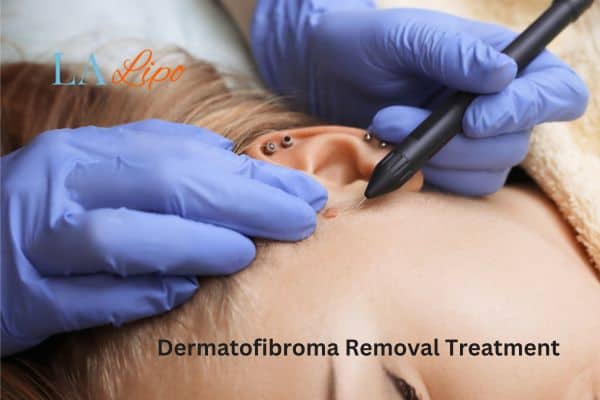 Dermatofibroma Removal Treatment Northwich
