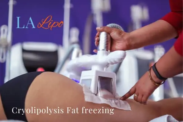 women getting fat freezing Northwich