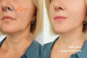 hi-fu for wrinkles Northwich before and after results