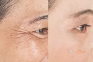 Before and after results of woman - HI-fu wrinkles reduction treatment Northwich