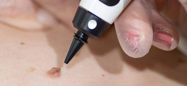 skin tag removal using cryopen Northwich