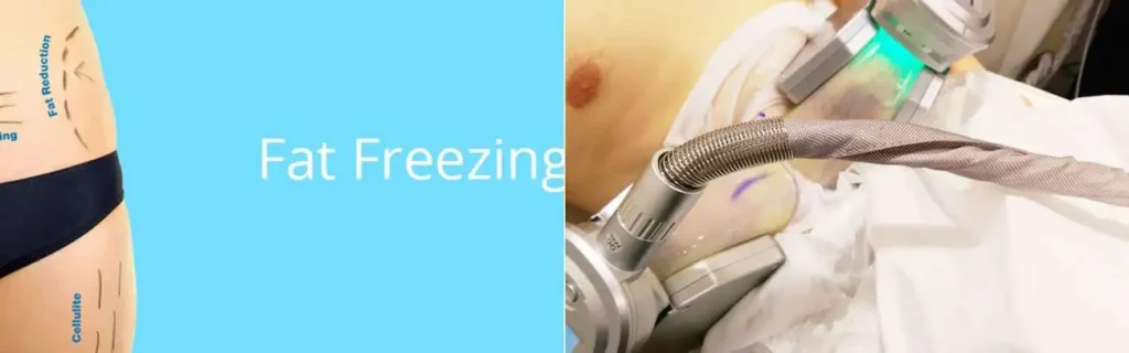 Fat freezing Northwich on multiple areas of the body