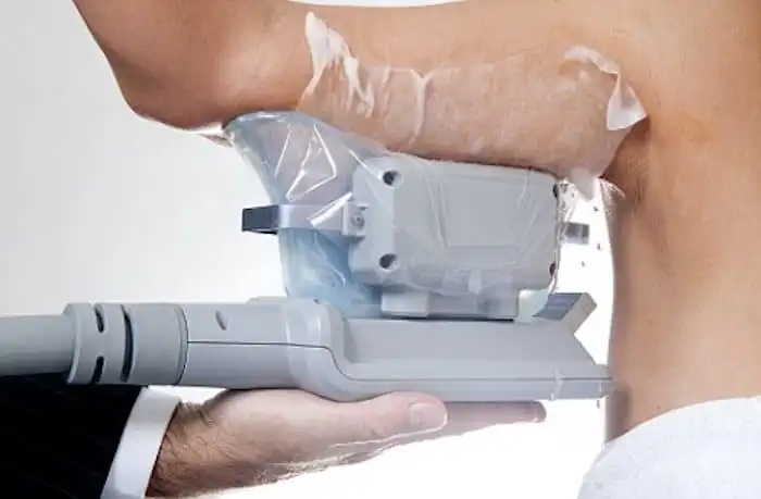 Picture of fat freezing Northwich on the upper arms.