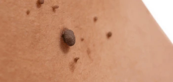image of a skin tag Northwich
