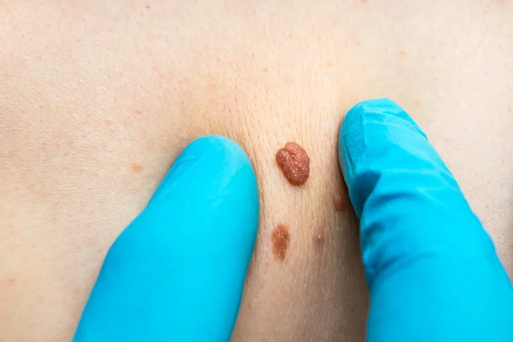 Consultant examining a skin tag Northwich