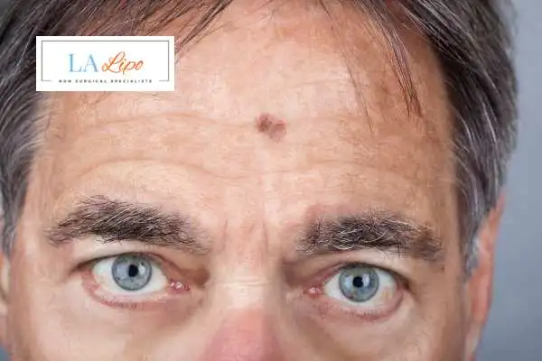 Solar Lentigo Removal Northwich image of man with mark on his forehead