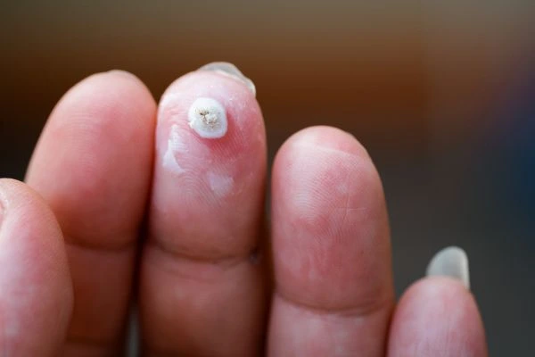 wart on person finger - cryotherapy to treat from LA LIPO Northwich