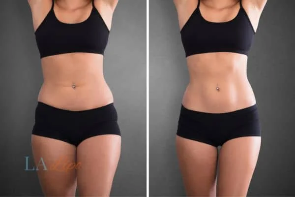 before and after results of non-surgical treatment to help a woman's body image and mental health Northwich