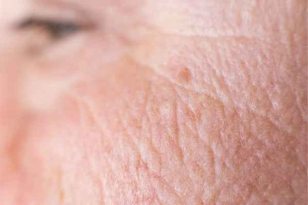 close up picture of a woman's face showing an age spot Northwich