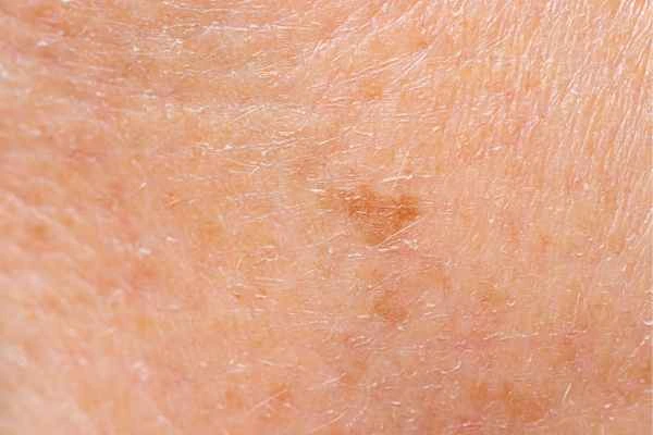 close up picture of age spots Northwich